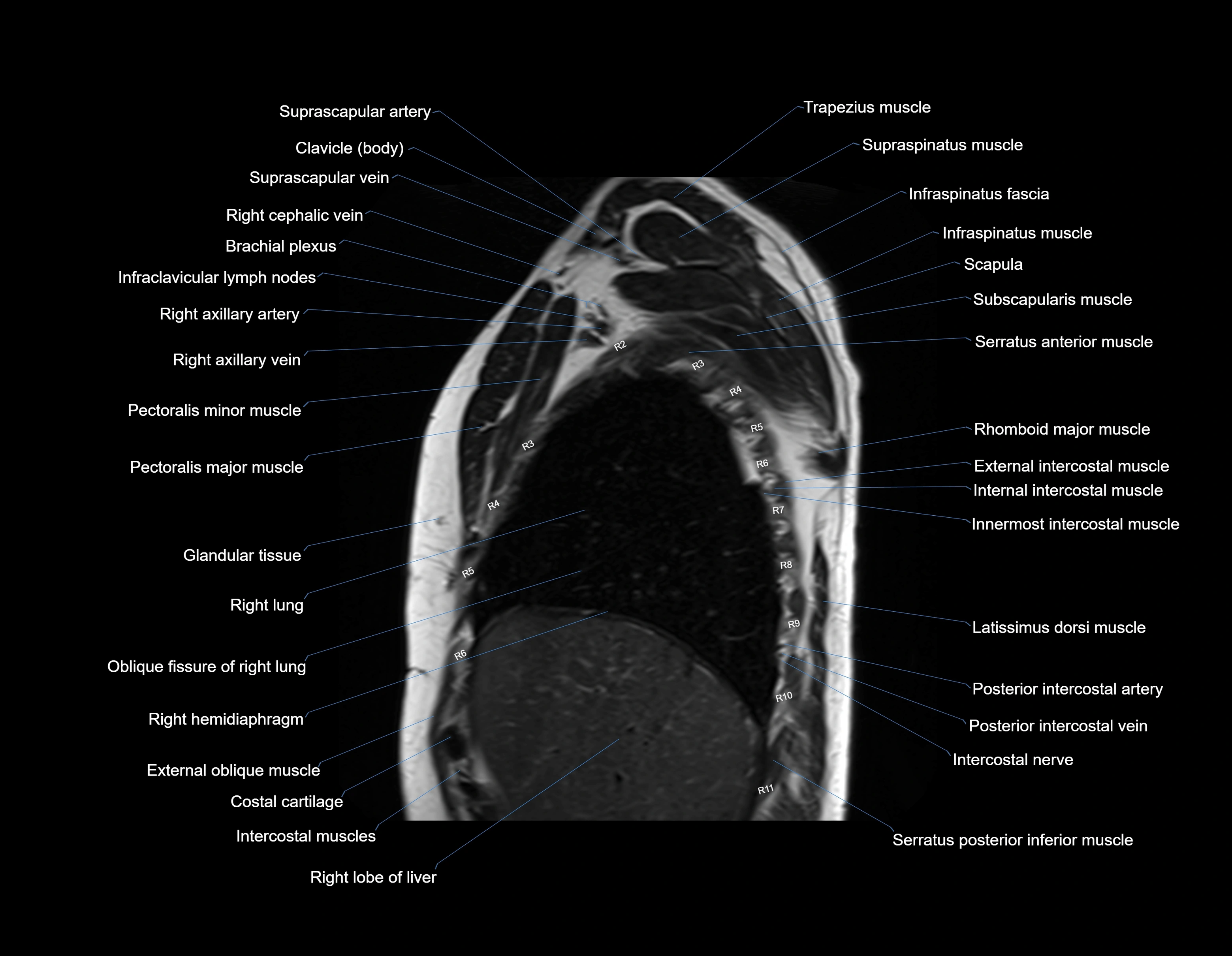 MRI chest (thorax) sagittal labelled cross sectional anatomy 3T radiology image-img-00001-00008.webp